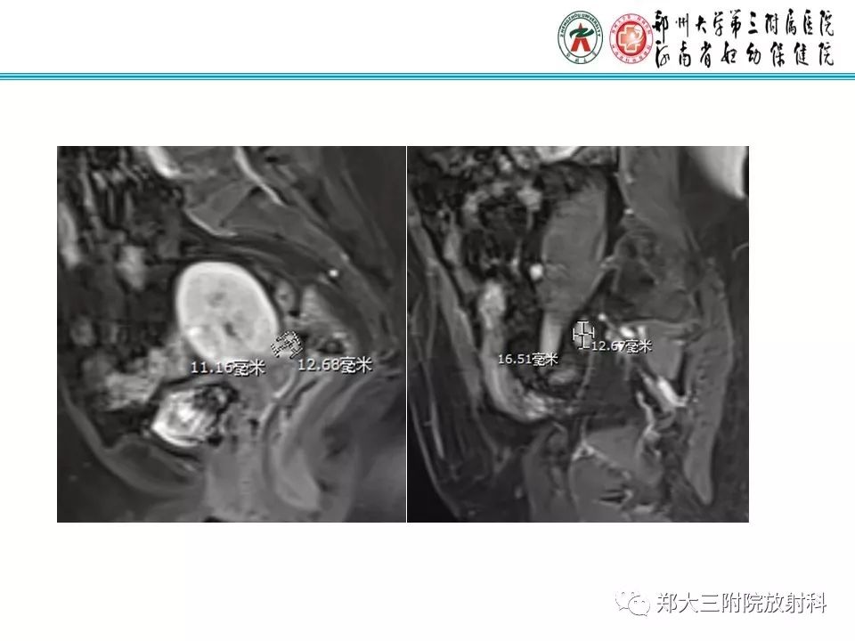 【PPT】如何判断盆腔肿瘤恶性淋巴结的转移 【PPT】如何判断盆腔肿瘤恶性淋巴结的转移