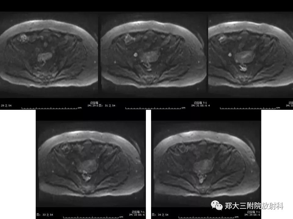 【PPT】如何判断盆腔肿瘤恶性淋巴结的转移 【PPT】如何判断盆腔肿瘤恶性淋巴结的转移