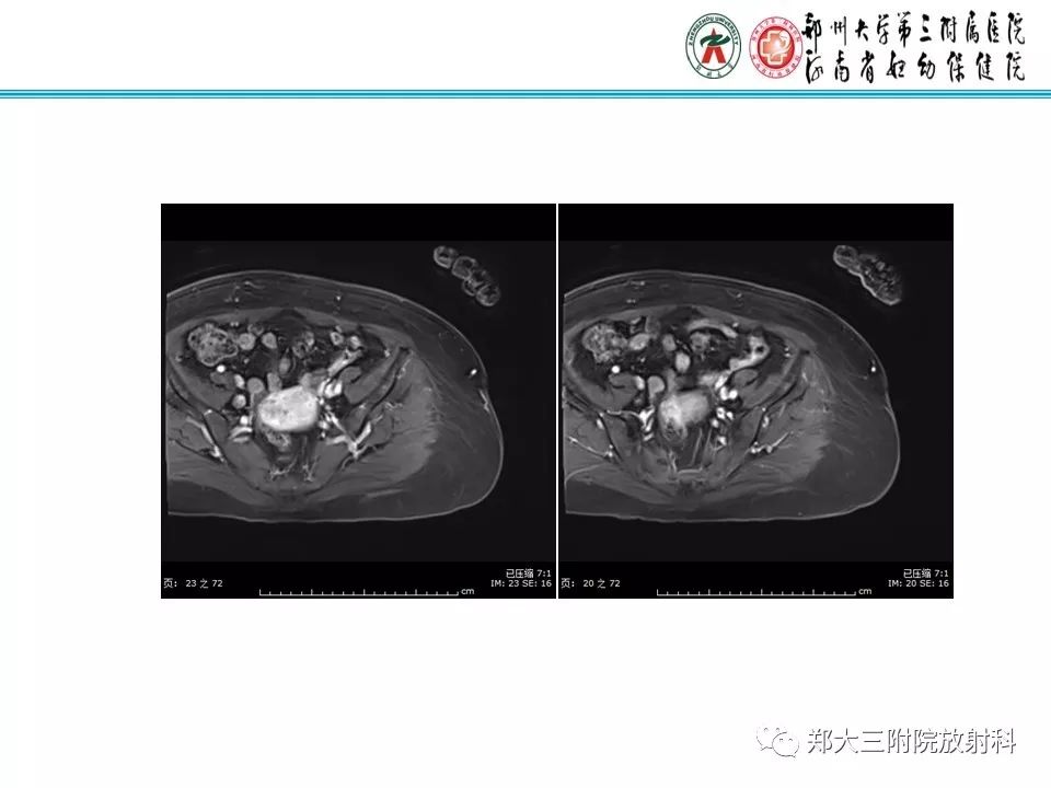 【PPT】如何判断盆腔肿瘤恶性淋巴结的转移 【PPT】如何判断盆腔肿瘤恶性淋巴结的转移