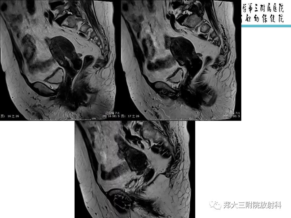 【PPT】如何判断盆腔肿瘤恶性淋巴结的转移 【PPT】如何判断盆腔肿瘤恶性淋巴结的转移