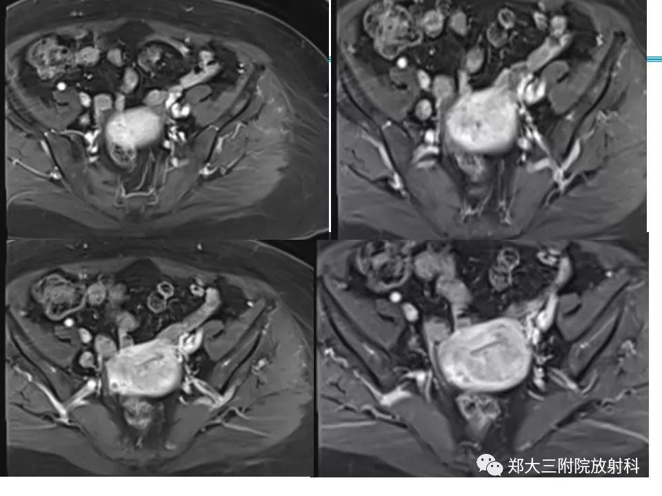 【PPT】如何判断盆腔肿瘤恶性淋巴结的转移 【PPT】如何判断盆腔肿瘤恶性淋巴结的转移