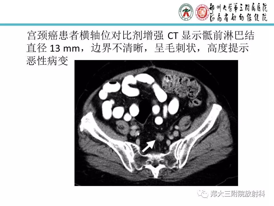 【PPT】如何判断盆腔肿瘤恶性淋巴结的转移 【PPT】如何判断盆腔肿瘤恶性淋巴结的转移