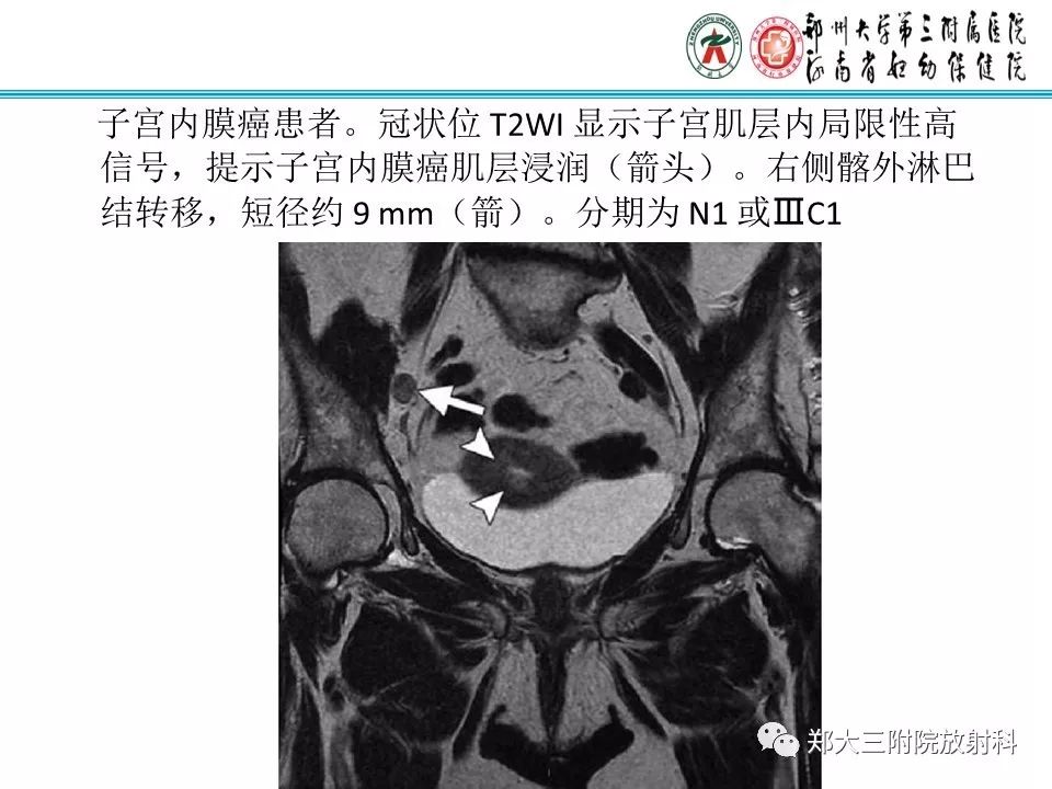 【PPT】如何判断盆腔肿瘤恶性淋巴结的转移 【PPT】如何判断盆腔肿瘤恶性淋巴结的转移