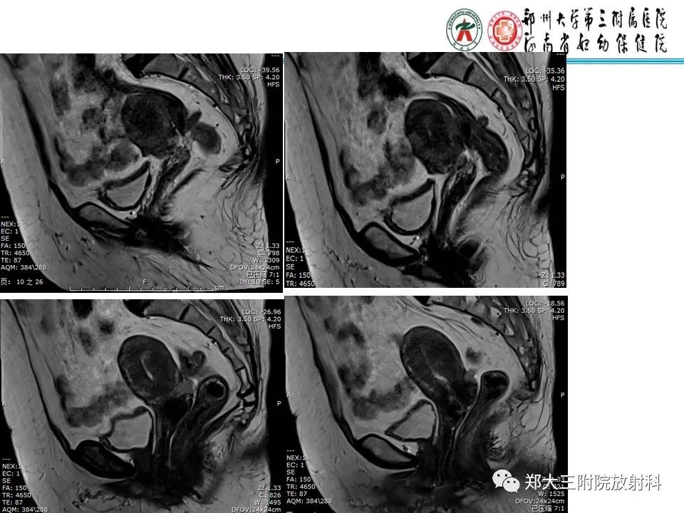 【PPT】如何判断盆腔肿瘤恶性淋巴结的转移 【PPT】如何判断盆腔肿瘤恶性淋巴结的转移