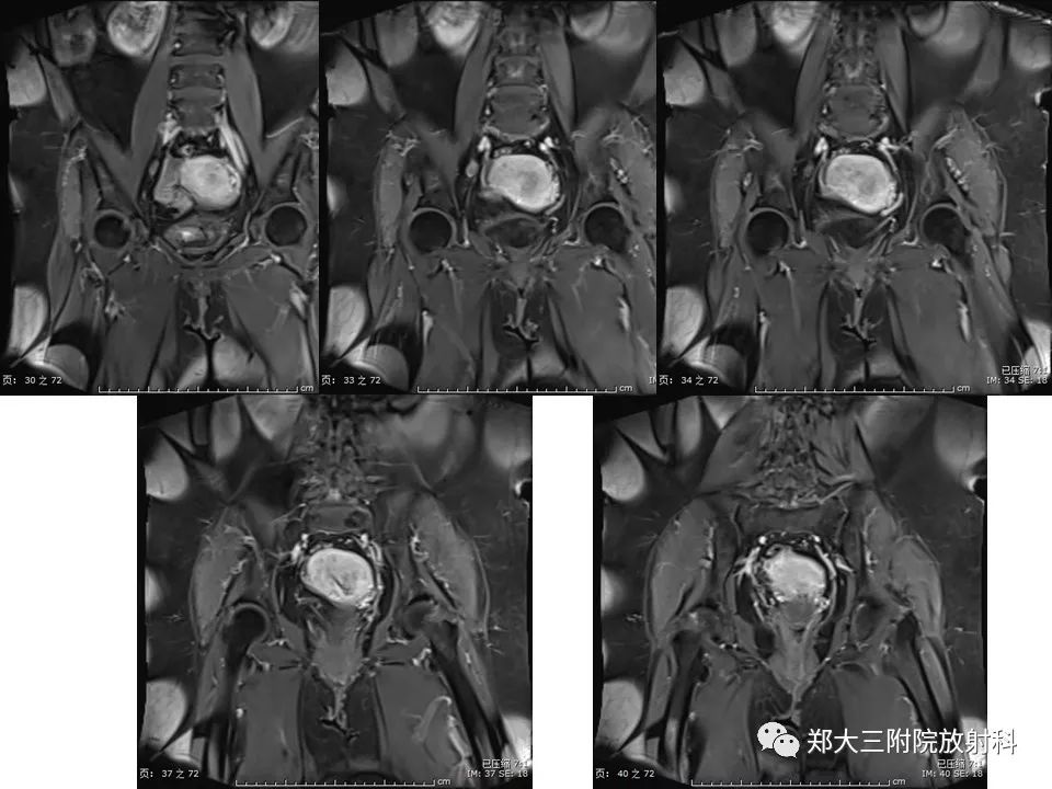 【PPT】如何判断盆腔肿瘤恶性淋巴结的转移 【PPT】如何判断盆腔肿瘤恶性淋巴结的转移