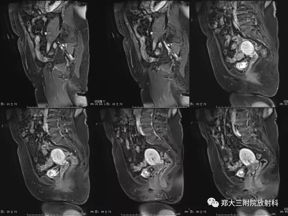 【PPT】如何判断盆腔肿瘤恶性淋巴结的转移 【PPT】如何判断盆腔肿瘤恶性淋巴结的转移