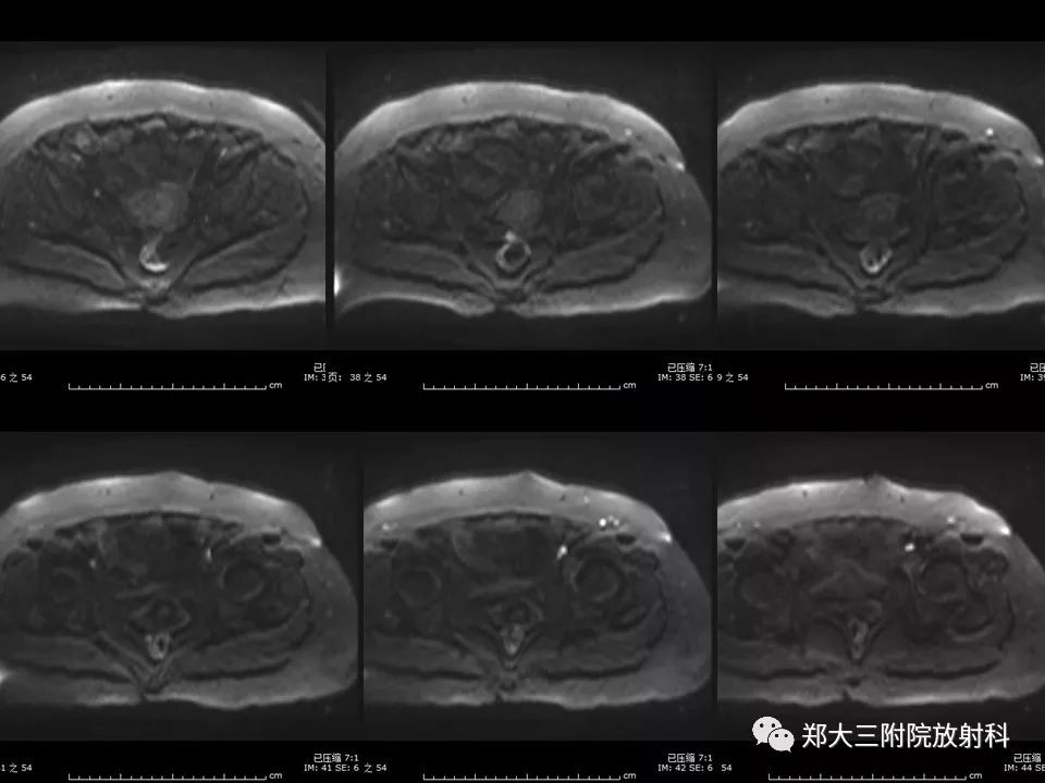 【PPT】如何判断盆腔肿瘤恶性淋巴结的转移 【PPT】如何判断盆腔肿瘤恶性淋巴结的转移