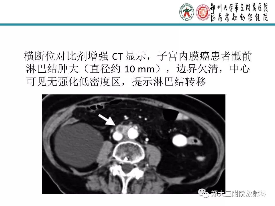 【PPT】如何判断盆腔肿瘤恶性淋巴结的转移 【PPT】如何判断盆腔肿瘤恶性淋巴结的转移