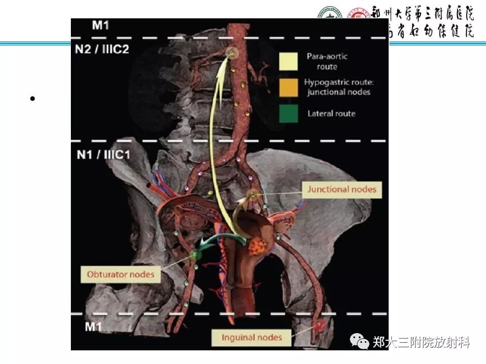 【PPT】如何判断盆腔肿瘤恶性淋巴结的转移 【PPT】如何判断盆腔肿瘤恶性淋巴结的转移
