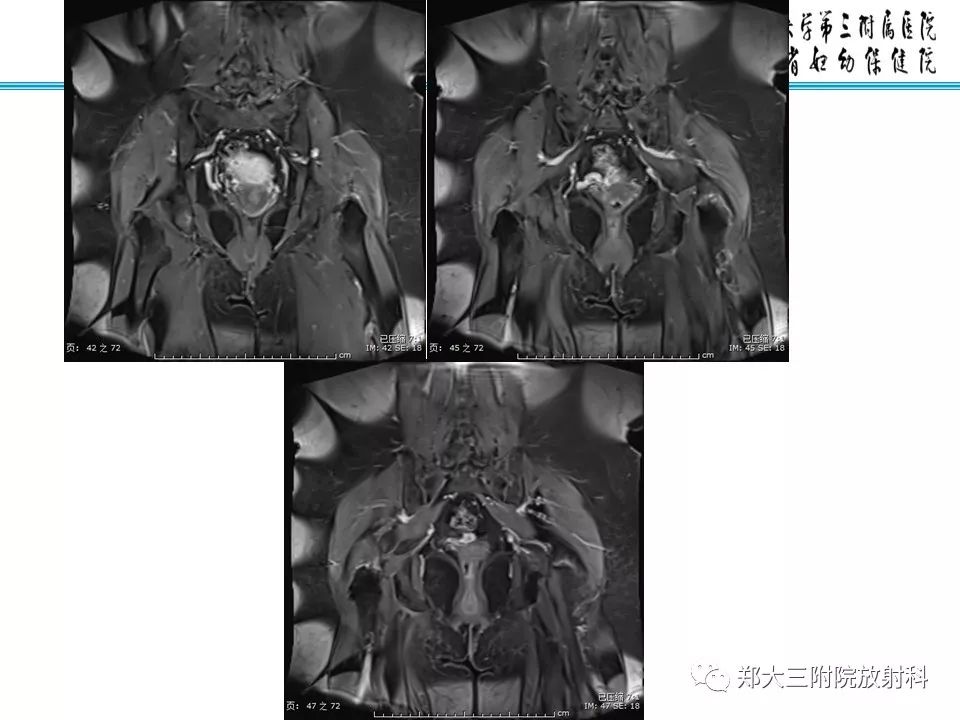 【PPT】如何判断盆腔肿瘤恶性淋巴结的转移 【PPT】如何判断盆腔肿瘤恶性淋巴结的转移