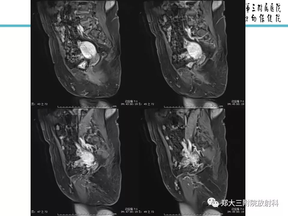 【PPT】如何判断盆腔肿瘤恶性淋巴结的转移 【PPT】如何判断盆腔肿瘤恶性淋巴结的转移