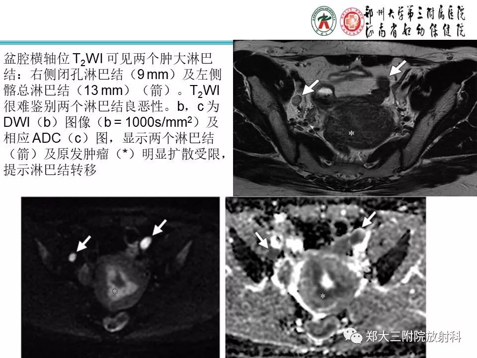 【PPT】如何判断盆腔肿瘤恶性淋巴结的转移 【PPT】如何判断盆腔肿瘤恶性淋巴结的转移