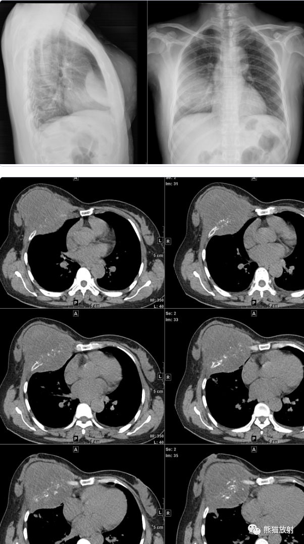 【病例】胸壁软骨肉瘤1例CT影像