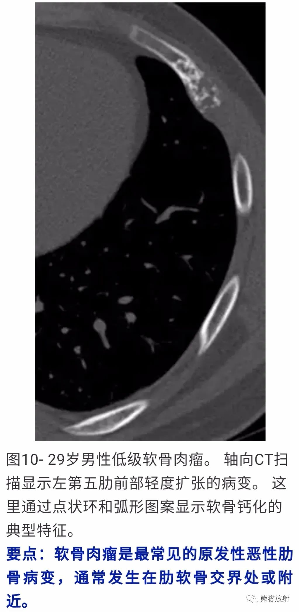 【病例】胸壁软骨肉瘤1例CT影像