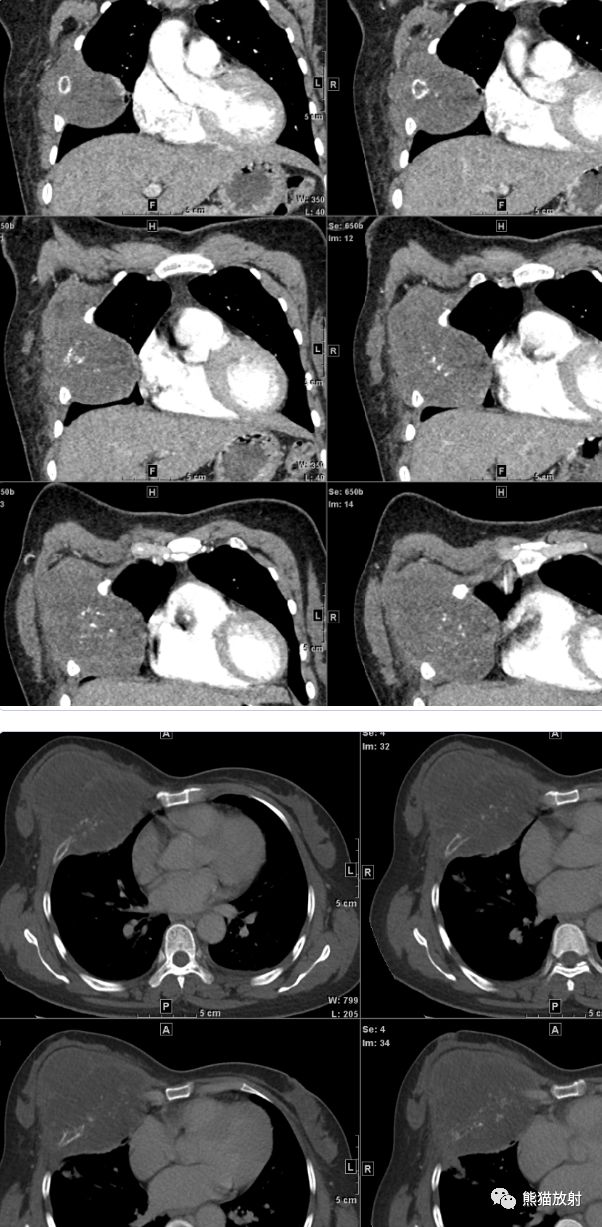 【病例】胸壁软骨肉瘤1例CT影像