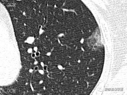 【病例】一眼识破的肺部新生物4例CT影像
