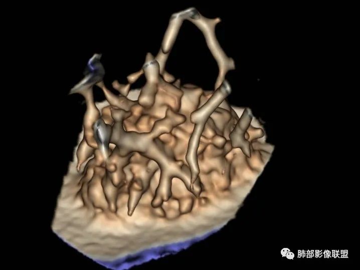 【病例】一眼识破的肺部新生物4例CT影像