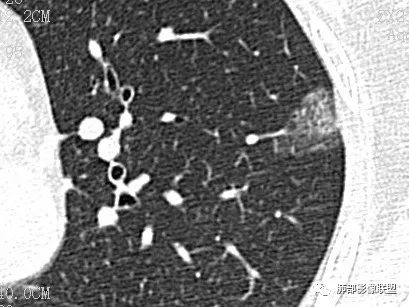 【病例】一眼识破的肺部新生物4例CT影像