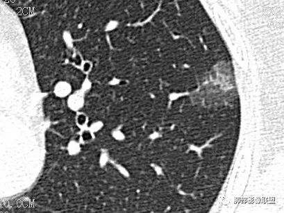 【病例】一眼识破的肺部新生物4例CT影像