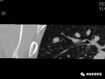 【病例】一眼识破的肺部新生物4例CT影像