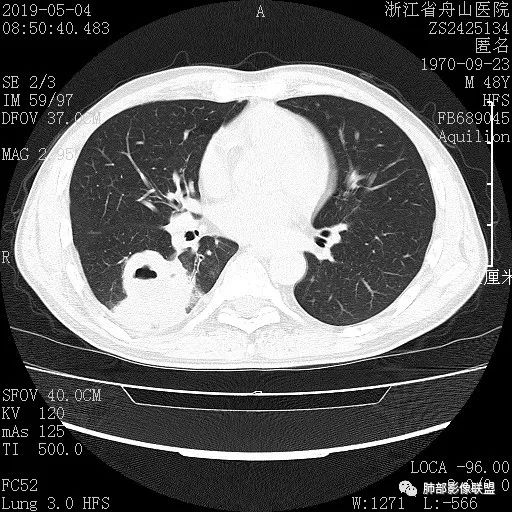 【病例】一眼识破的肺部新生物4例CT影像
