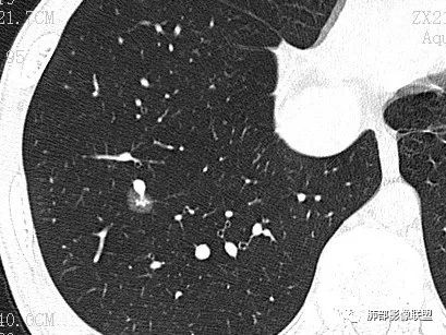 【病例】一眼识破的肺部新生物4例CT影像