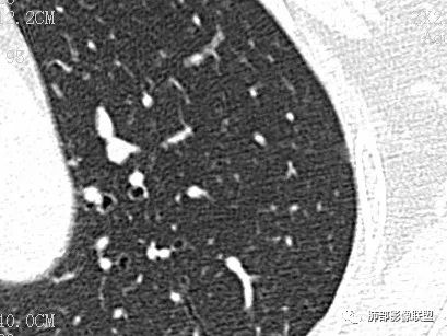 【病例】一眼识破的肺部新生物4例CT影像