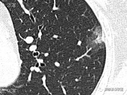 【病例】一眼识破的肺部新生物4例CT影像