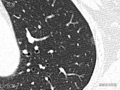 【病例】一眼识破的肺部新生物4例CT影像