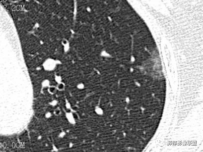 【病例】一眼识破的肺部新生物4例CT影像