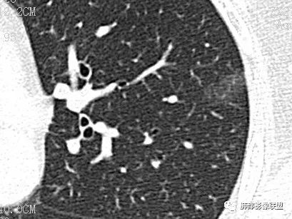 【病例】一眼识破的肺部新生物4例CT影像