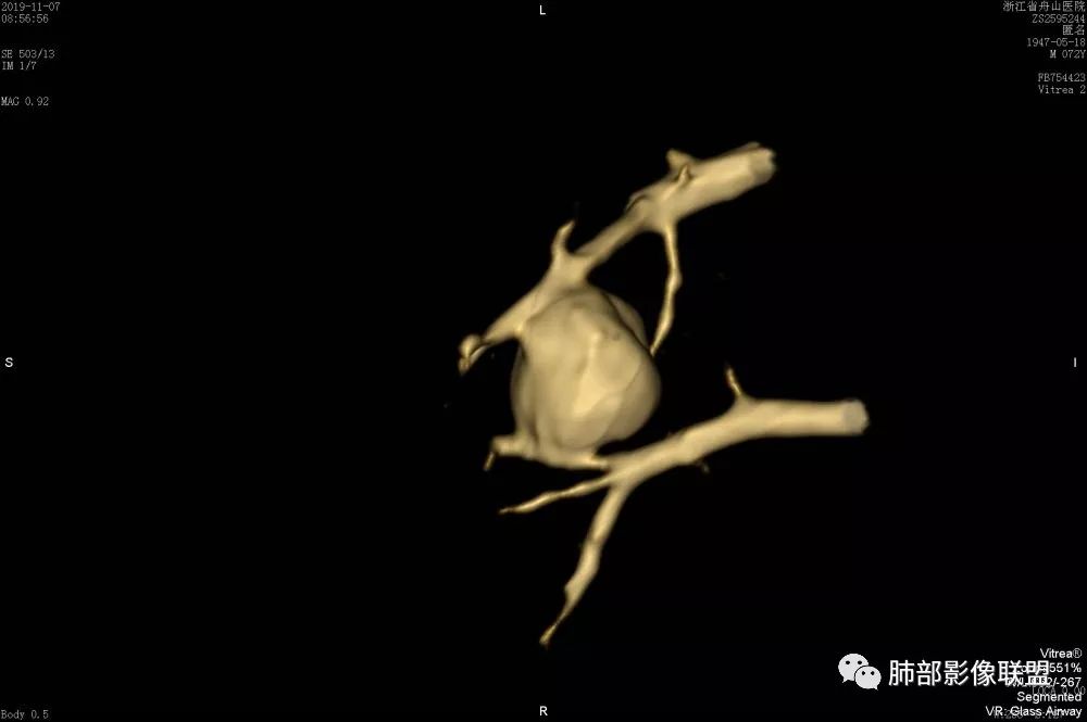 【病例】一眼识破的肺部新生物4例CT影像