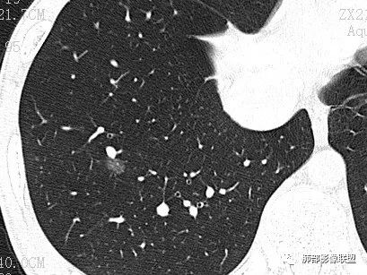 【病例】一眼识破的肺部新生物4例CT影像