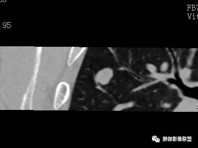 【病例】一眼识破的肺部新生物4例CT影像