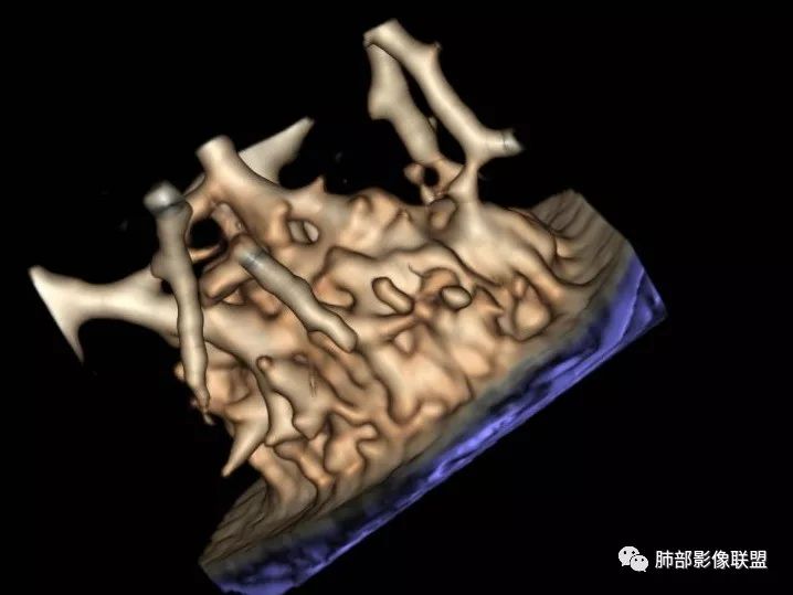【病例】一眼识破的肺部新生物4例CT影像
