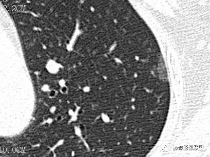 【病例】一眼识破的肺部新生物4例CT影像