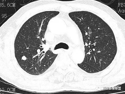 【病例】一眼识破的肺部新生物4例CT影像
