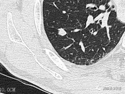 【病例】一眼识破的肺部新生物4例CT影像