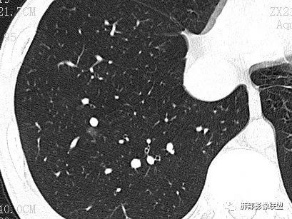 【病例】一眼识破的肺部新生物4例CT影像