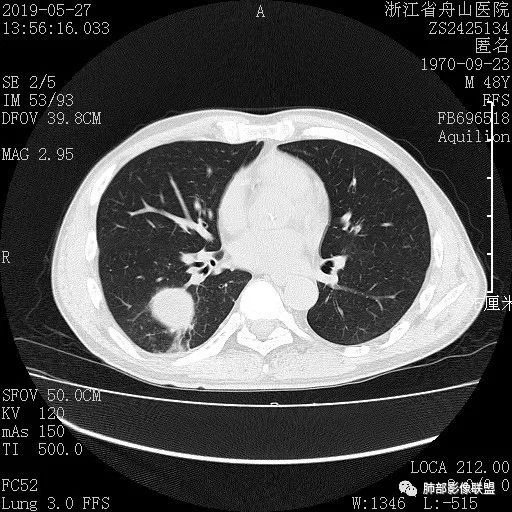 【病例】一眼识破的肺部新生物4例CT影像