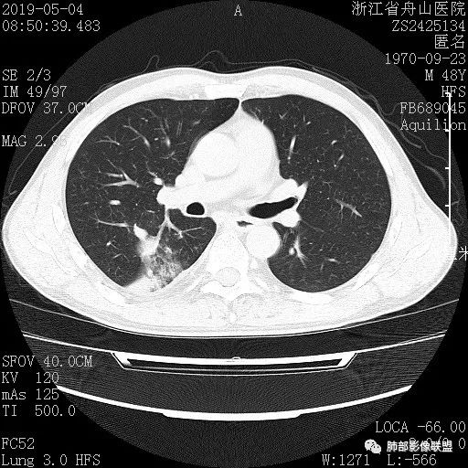 【病例】一眼识破的肺部新生物4例CT影像