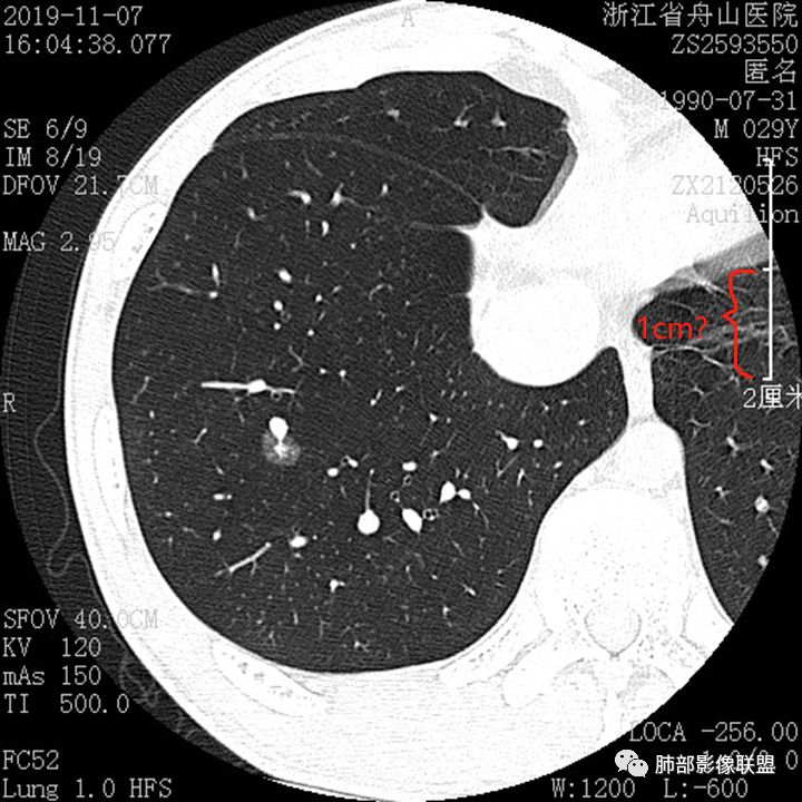【病例】一眼识破的肺部新生物4例CT影像