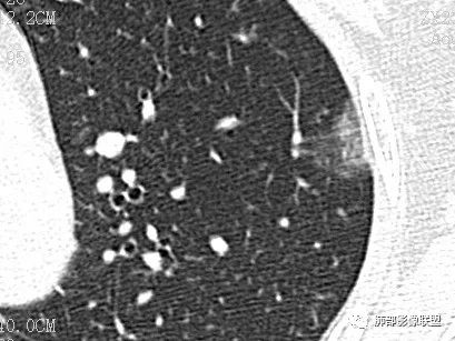 【病例】一眼识破的肺部新生物4例CT影像