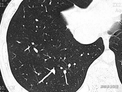 【病例】一眼识破的肺部新生物4例CT影像