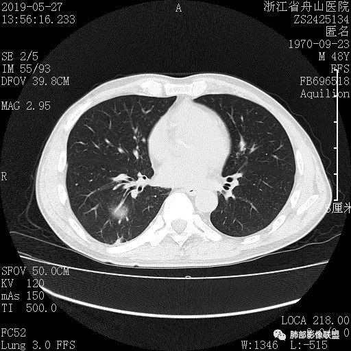 【病例】一眼识破的肺部新生物4例CT影像