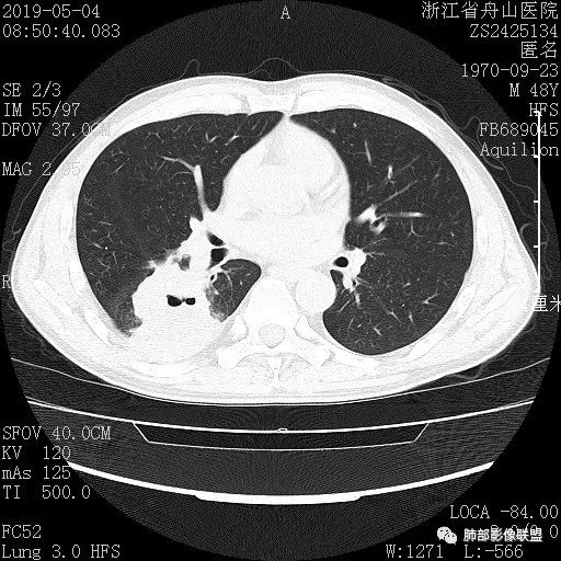 【病例】一眼识破的肺部新生物4例CT影像