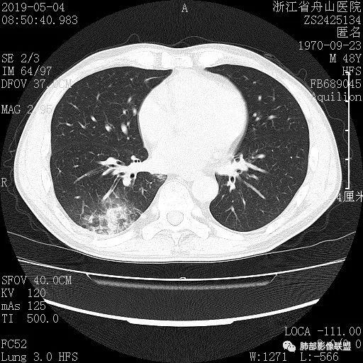 【病例】一眼识破的肺部新生物4例CT影像
