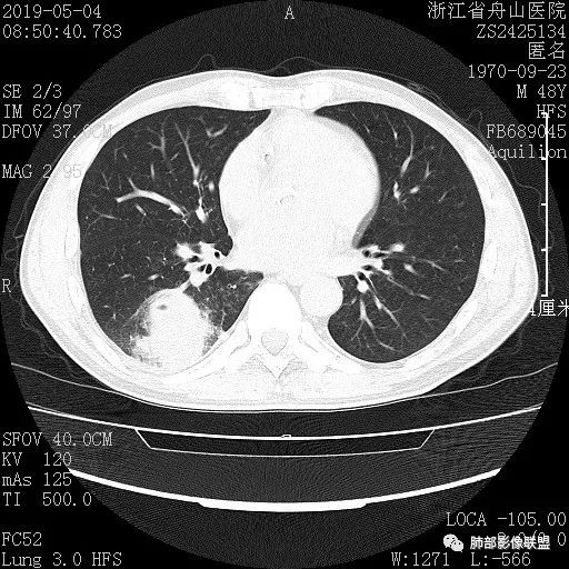 【病例】一眼识破的肺部新生物4例CT影像