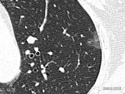 【病例】一眼识破的肺部新生物4例CT影像