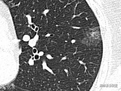 【病例】一眼识破的肺部新生物4例CT影像